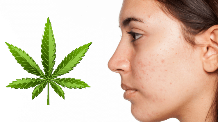 Weed and acne 420.mt Cannabis and Your Skin…What’s the positive best connection?